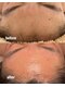リルビー(Lilby)の写真/感動の艶肌へ。フェイシャルワックスで毛穴汚れや産毛をスッキリ。施術直後から驚きのつるすべ肌に！