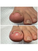 ネイルサロンアンドスクール ペルシャ(Persia)/巻き爪ケア