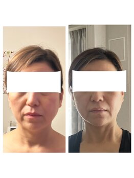 サロン ド ルポゼ(Salon de Reposer)/サーマナイフ＋小顔矯正