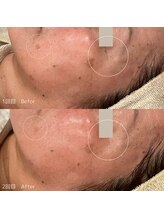 ハル(haru)/ビフォーアフター