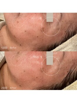 ハル(haru)/ビフォーアフター