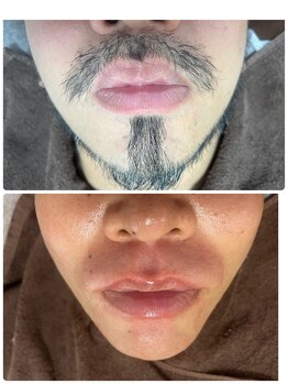 ラピス(Lapis)/人気のヒゲワックス脱毛