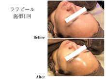 フレイヤ(FREYA)/ララピールBefore→After