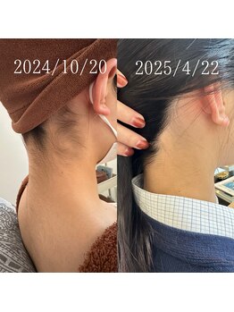 アゲハ(ageha)/レディース/うなじ脱毛