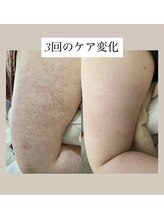 スキンプローズ(skinprose)/二の腕ハーブピーリング・ハード