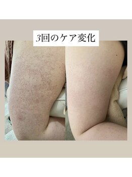 スキンプローズ(skinprose)/二の腕ハーブピーリング・ハード