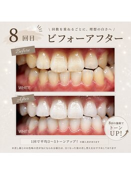 ホワイト 上乃木南店(WHITE)/8回目ビフォーアフター