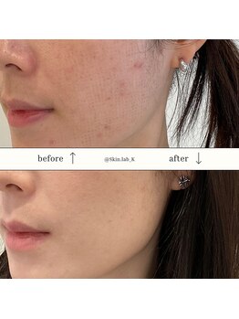 スキン ラボ ケー(Skin lab K)/高周波プラズマアクネケア