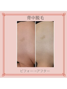 ノノ(nono)/背中も脱毛♪