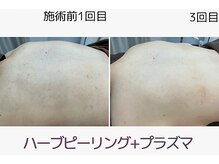 ウェルビー(Well-Be)/ハーブピーリング＋プラズマ導入