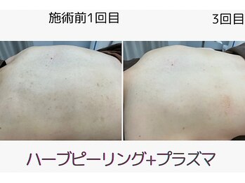 ウェルビー(Well-Be)/ハーブピーリング＋プラズマ導入