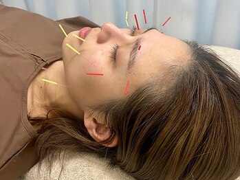 加島鍼灸接骨院/鍼が初めての方でも