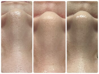 サロン ラズリ 久留米店(SALON Lazuli)/【毛穴洗浄】古い角栓も一掃！