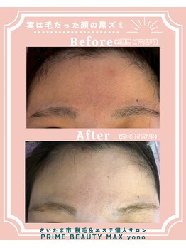 マックス 与野店(MAX)/黒ずみだと思ってたら毛だった！