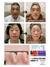 エヌフェイシャル(N.facial)/施術一回でこの効果！