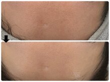 エフェクト 塚口店(effect)/Before After &nbsp;&nbsp;30代/1回目