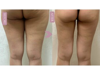 ブリス 渋谷駅前(BliSS)/長年のセル脂肪に脚スキマ革命！