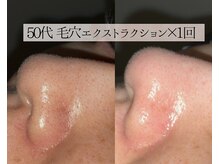 ル シーニュ/毛穴エクストラクション