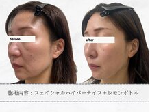 エメ 名古屋栄店(aimer)/レモンボトル<小顔・脂肪分解>