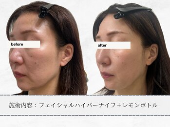 エメ 名古屋栄店(aimer)/レモンボトル<小顔・脂肪分解>