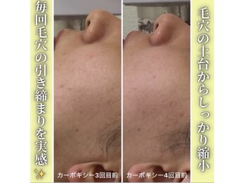 ハニエル(Haniel)/カーボキシー症例