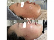 エステティック リベル キョウト 京都駅前店(Esthetic Liber Kyoto)/肌質改善ピーリング