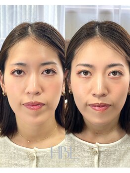 エントワ(ENTOWA)/毛の無いところもカバー
