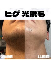 ビビユー(bibi u)/ヒゲ光脱毛 ビフォーアフター