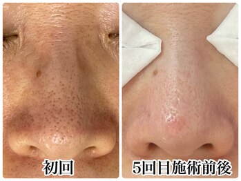 スナグル(Snuggle)/毛穴改善コース