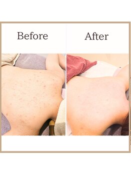 サロンルーチェ(Salon Luce)/背中トリートメント/背中ニキビ