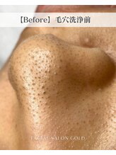 ゴールド 栄店(GOLD)/【Ｂefore】毛穴洗浄前