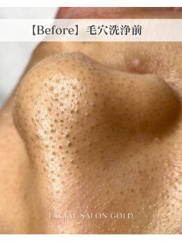 ゴールド 栄店(GOLD)/【Before】毛穴洗浄前