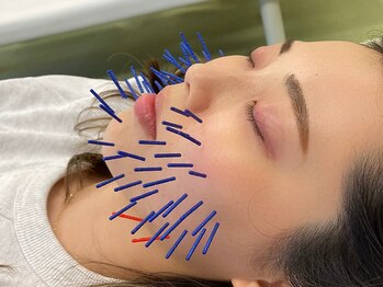 モンダロ(MONDARO)の写真/美容鍼でツルスベ肌に！エステとは一味違う！たるみケアで目指す小顔体験が人気です★