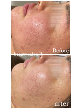 ビューティサロン アール(R)/ボコボコしたお肌お悩みも改善