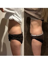 エミナル(Eminal)/◆脂肪冷却　お腹　1回