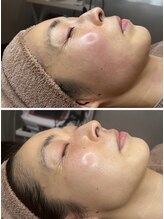 モモ(momo)/気になる赤ら顔ケア