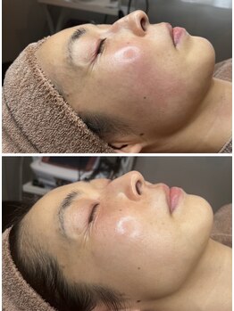 モモ(momo)/気になる赤ら顔ケア