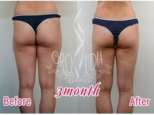 グラウディア 恵比寿/痩身/筋膜リリース/インディバ超