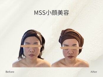 ホリスティックサロン ヘルバ(Holistic salon Herba)/MSS小顔美容施術変化
