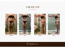 ハンズ鍼灸接骨院小牧院 美容整体ハンズ(美容整体hands)/痩身 before after