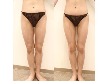 デンオブ(Den of)/【痩身ダイエット】WINBACK 美脚