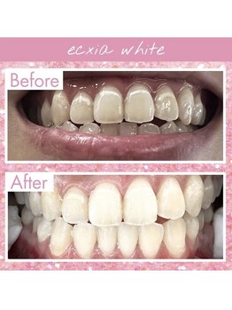 エクシアホワイトニング 天王寺店/ホワイトニングビフォーアフター