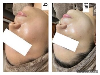 ヘルスアンドビューティー シーズスパ(CSY's SPA)/白透ハーブピーリングで美白に！