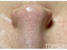 トップスキン 名駅(TOPSKIN)/毛穴洗浄＋ハーブの相乗効果◎