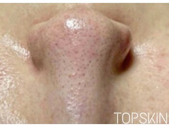 トップスキン 名駅(TOPSKIN)/毛穴洗浄+ハーブの相乗効果◎