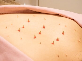 仙灸堂/刺激の少ない優しい施術