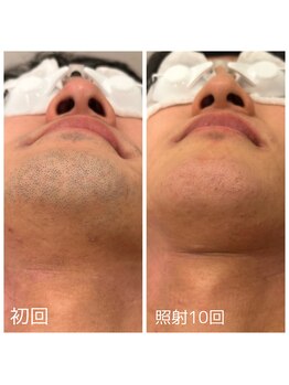 ダリオムズ 西宮北口(DAHLI HOMMES)/☆メンズヒゲ脱毛☆施術10回目