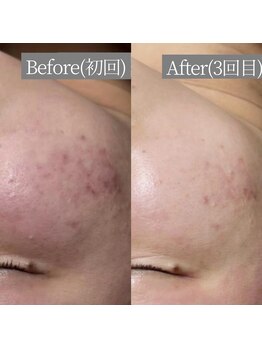 ホワイトアクア 鳳店(WHITE AQUA)/ハーブピーリング 3回目 ニキビ