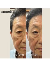 エビスラボ(Ebisu Labo)/リフトアップ