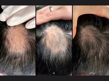 キュライム 熊本(CURAIM)/育毛促進【40代男性】